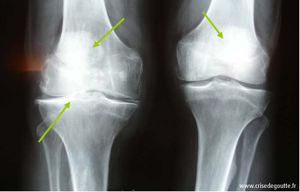 Radiographie des genoux montrant la présence d'une chondrocalcinose