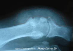 Radiographie centrée sur l’articulation métatarsophalangienne d’un doigt. Présence de lésions osseuses et de tophus dans les parties molles (contour en pointillés)