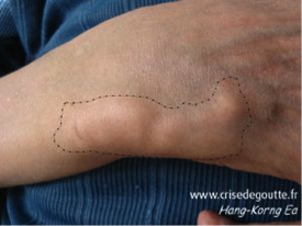Tophus au niveau d'un ligament du poignet (contour en pointillés)
