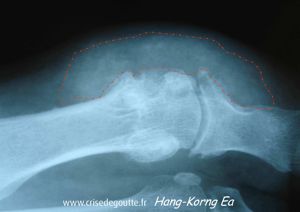 Tophus MTP1 Tophus MTP1