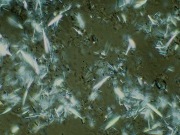 Microcristaux d'urate Microcristaux d'urate