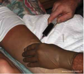 Ponction du liquide intra-articulaire